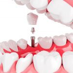 ΟΔΟΝΤΙΑΤΡΟΣ-ΑΘΗΝΑ-ΛΙΑΡΟΜΑΤΗ-ΠΕΝΝΥ